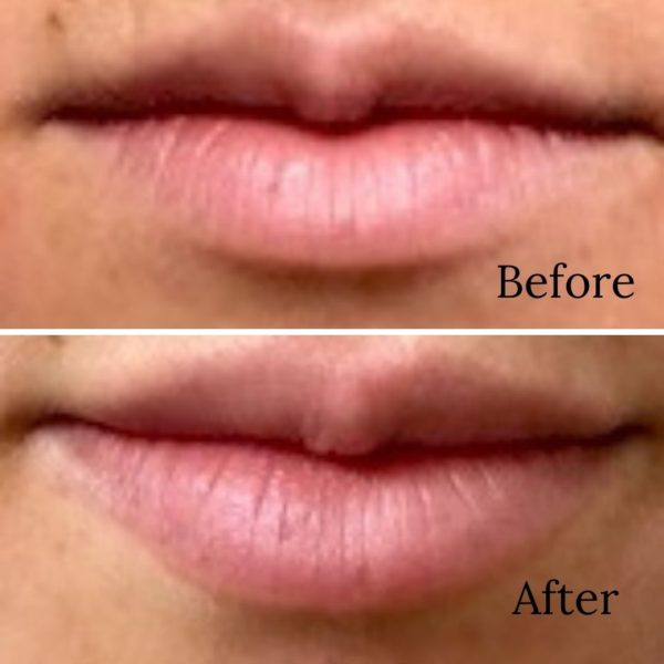 Juvederm Lips Before After
